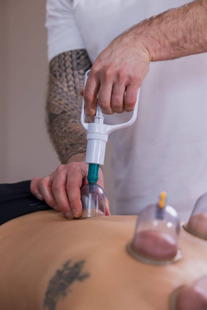Schröpfen zur Behandlung von Schmerzen am Bewegungsapparat